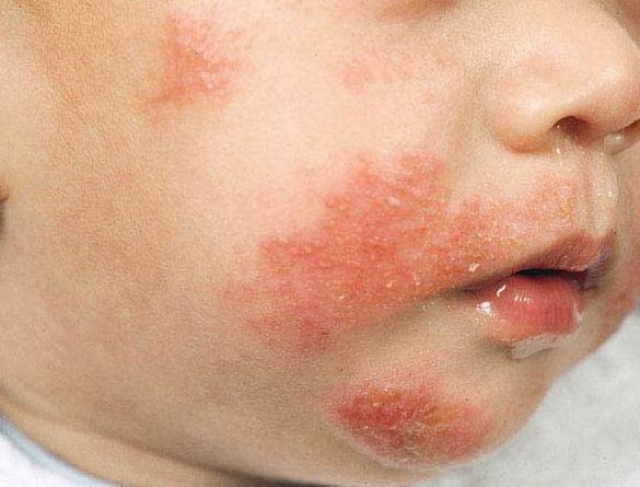 atopijski dermatitis kod djece