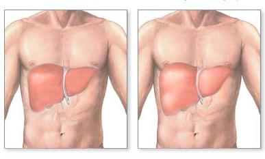 hepatomegalija difuzne promjene jetre