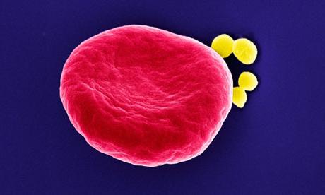 kako liječiti staphylococcus aureus